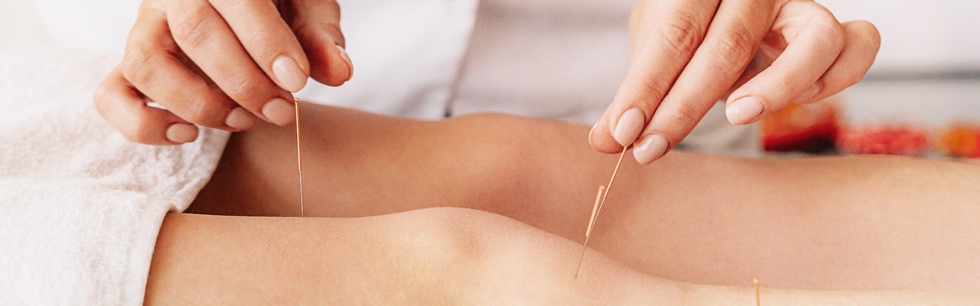 Example of dry needling with acupuncture at Holmwood Clinic